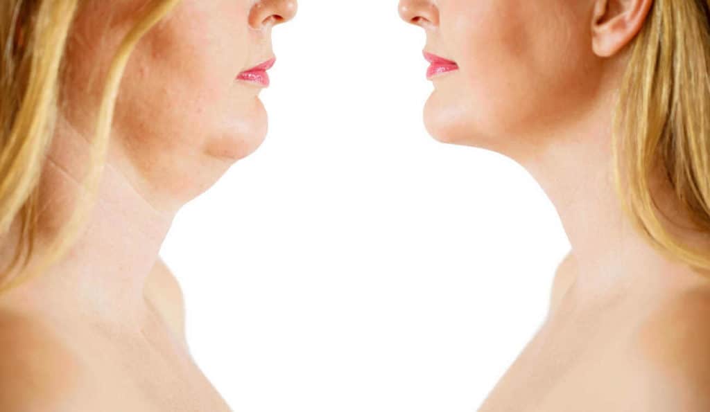 Double Chin treatment Luton before and after results