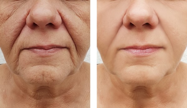 Learn more about Morpheus8 Treatment Luton today!