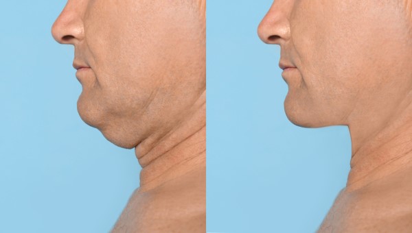 Which Non-Surgical Treatments Work Best for Jowls and Loose Skin Luton?