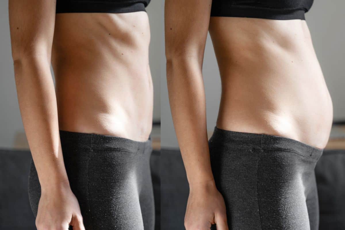 How long does diastasis recti take to improve Luton?