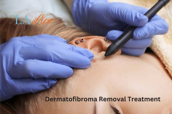 Dermatofibroma Removal Treatment Luton