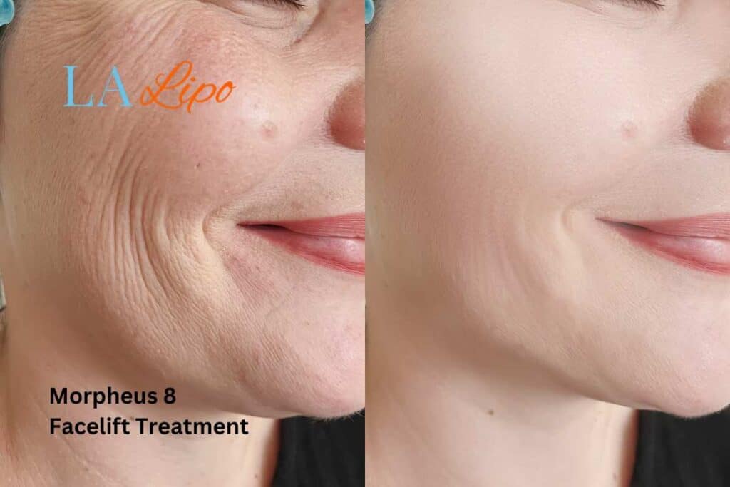 Morpheus8 Treatment Luton for flawless skin! Call us today!