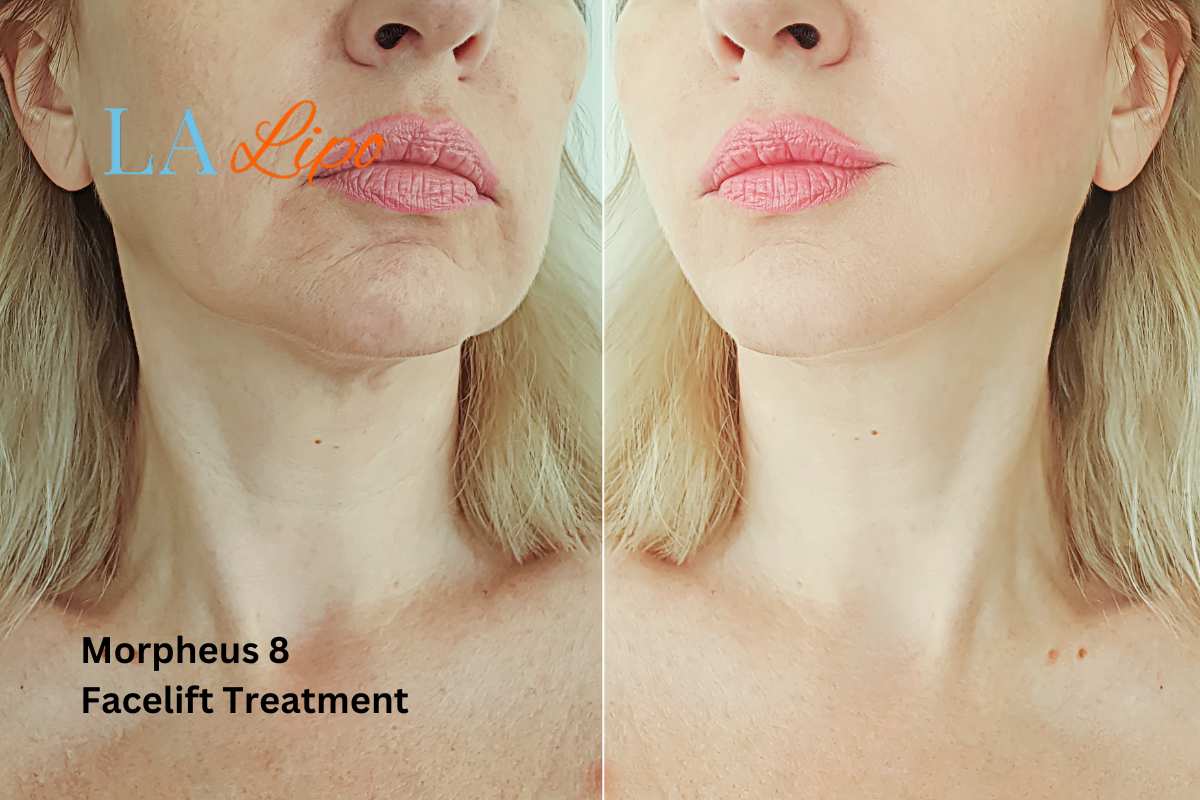 Turn back time with Morpheus8 Treatment Luton
