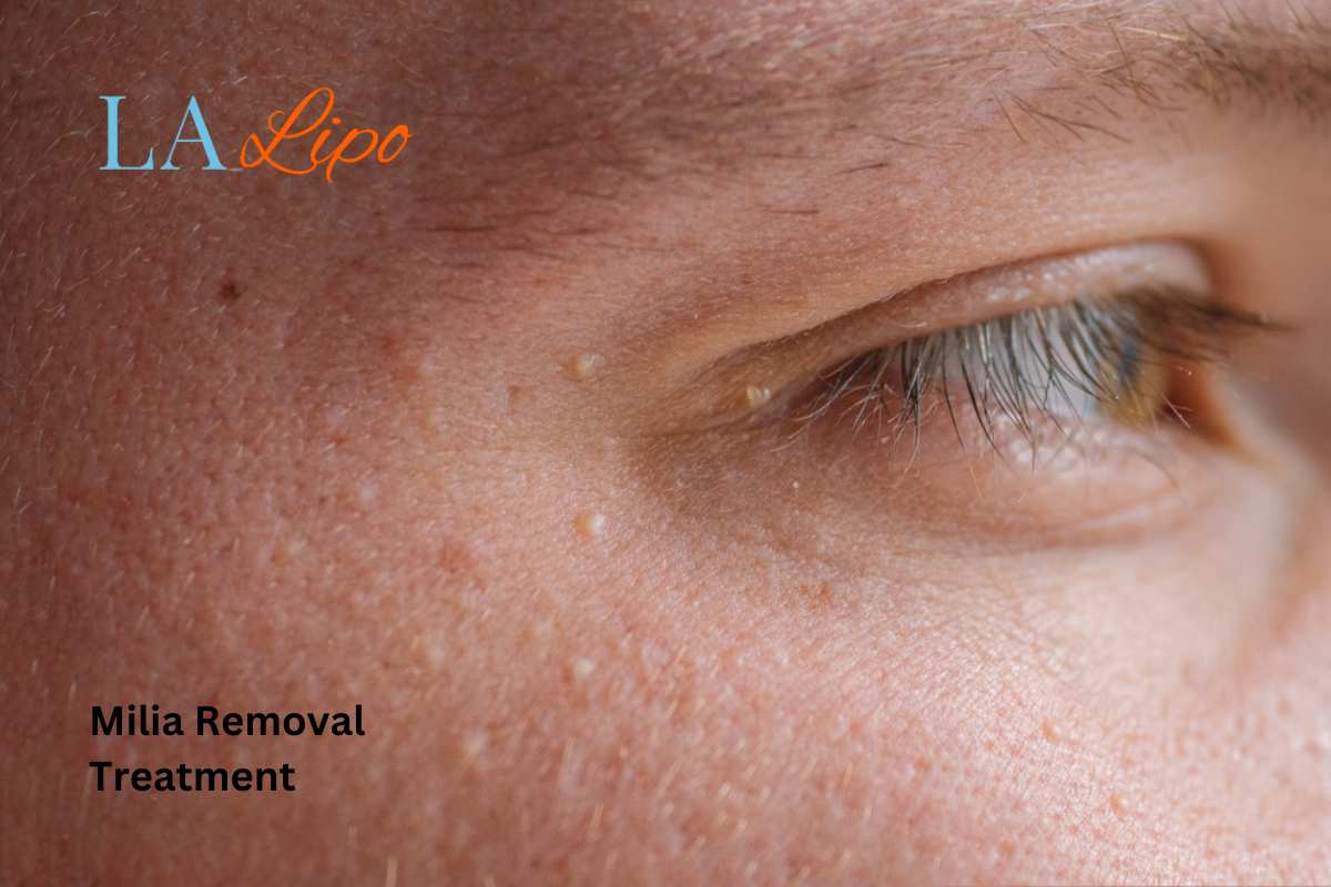Cryopen Milia Removal: Is It the Easiest and Safest Option Luton?