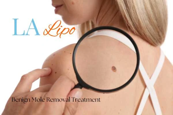 Why getting moles removed Luton can boost your confidence!