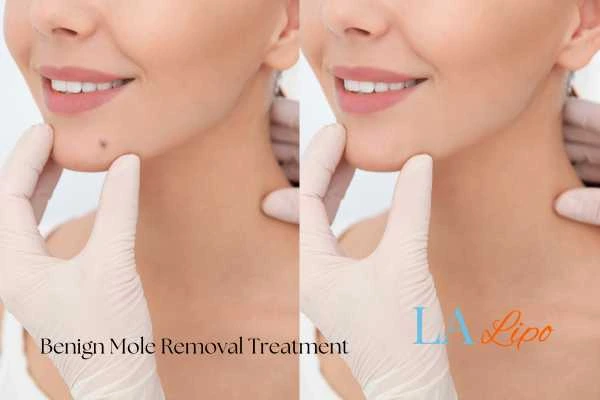 Woman's before and after results of being moles removal treatment Luton