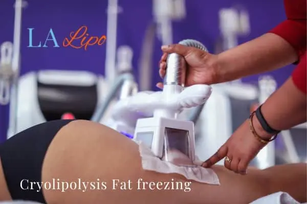 women getting fat freezing Luton