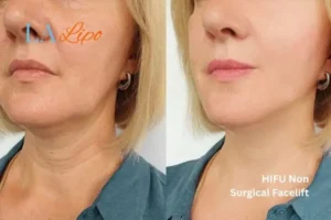 hi-fu for wrinkles Luton before and after results