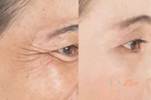 Before and after results of woman - HI-fu wrinkles reduction treatment Luton