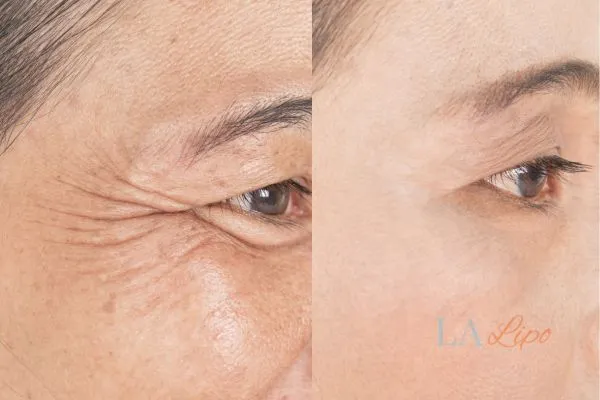 Before and after results of woman - HI-fu wrinkles reduction treatment Luton