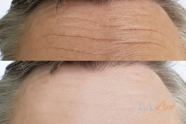 results of HIFU Luton on mans forehead to help reduce lines and wrinkles