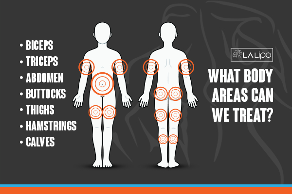 Graphic to show areas you can have LA-EMS Body Sculpting Luton treatment.