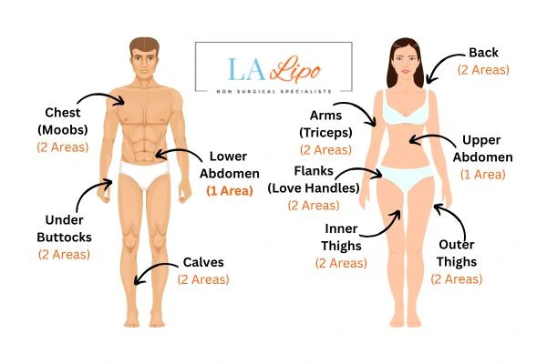 LA LIPO Cryolipolysis Areas Luton