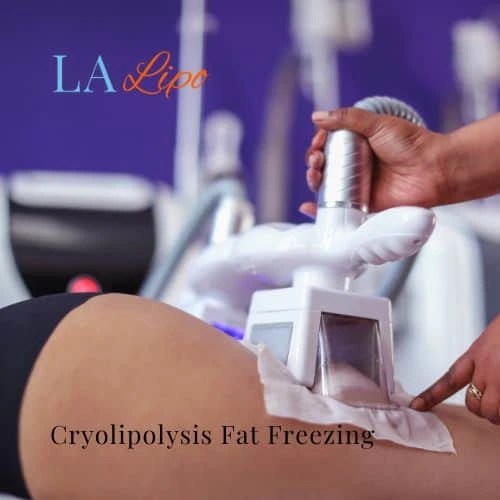 fat freezing - Cryolipolysis Luton