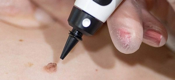 skin tag removal using cryopen Luton