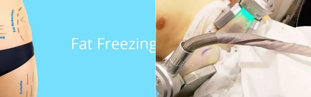 multi areas of a persons body having coolsculpting Luton treatment