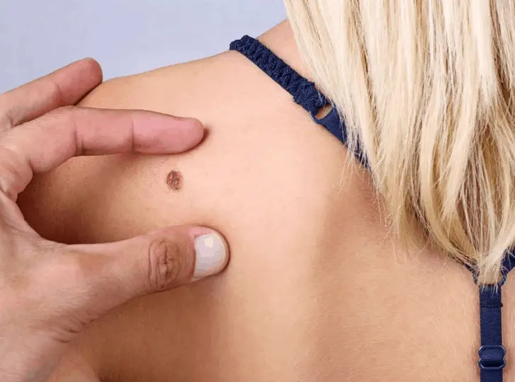 woman having mole removal Luton consultation before treatment.