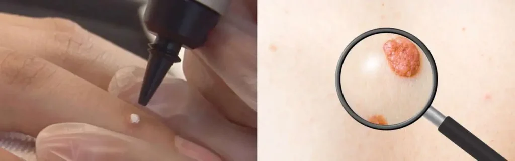 Cryopen for mole removal Luton - speak to our team today!