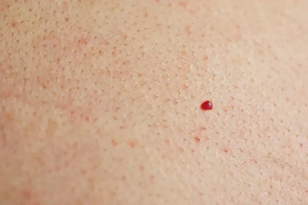close up of a cherry angioma Luton