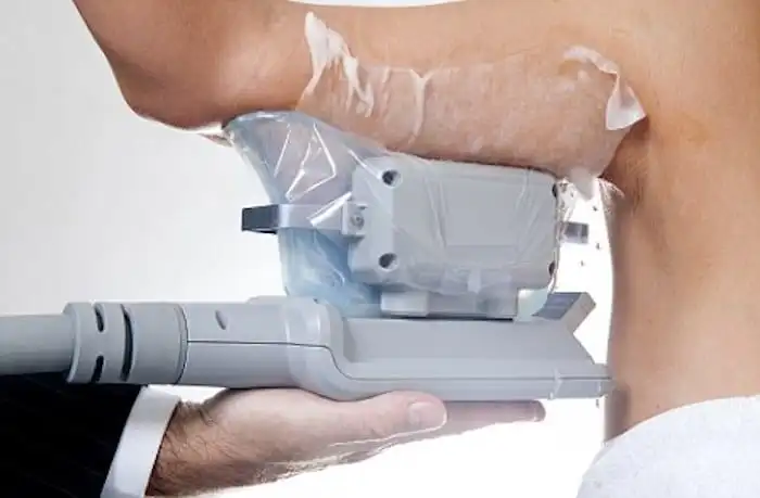 Picture of fat freezing Luton on the upper arms.