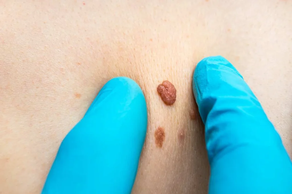 Consultant examining a skin tag Luton