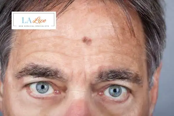 Solar Lentigo Removal Luton image of man with mark on his forehead
