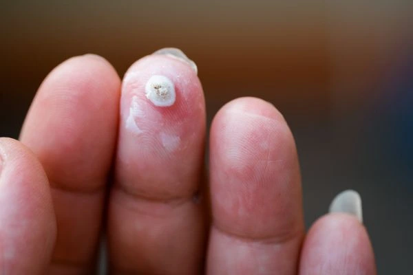 wart on person finger - cryotherapy to treat from LA LIPO Luton