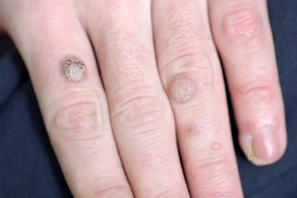 photo of warts on person hand - see wart removal Luton from LA LIPO