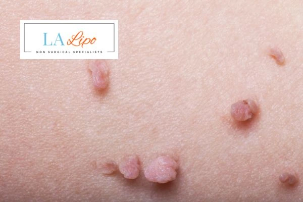 Does cryopen skin tag removal Luton hurt? Find out now call our team today!