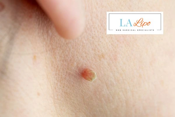 Book skin tag removal Luton today speak to our team now!