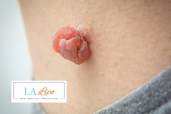 Interested in skin tag removal Luton? Concerned about the pain? Find out more today!
