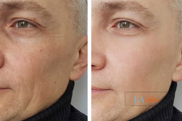 See the amazing results of Morpheus8 Treatment Luton!