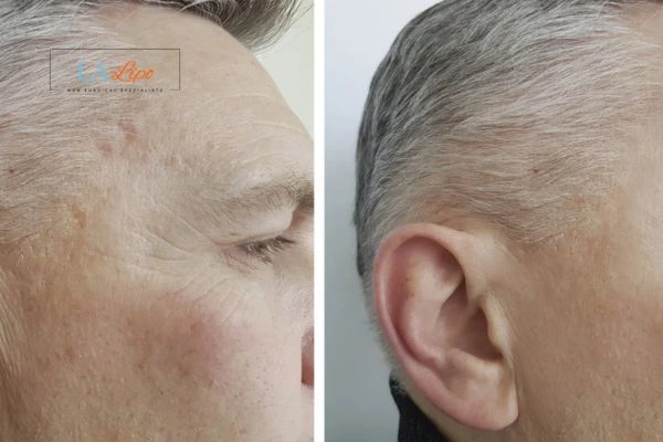 Mens Before & After Morpheus 8 Results Luton