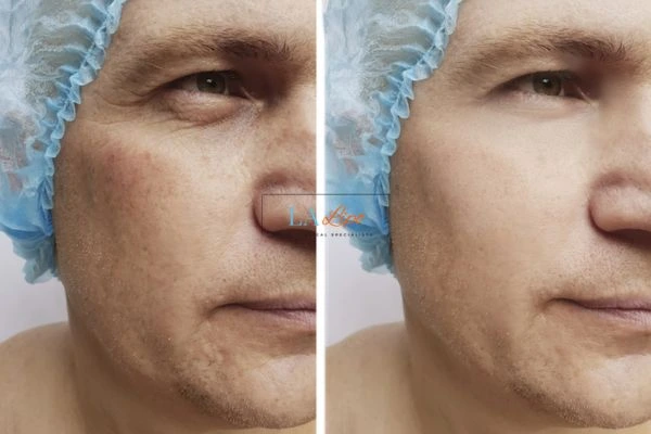 Before and after Morpheus 8 Results Luton