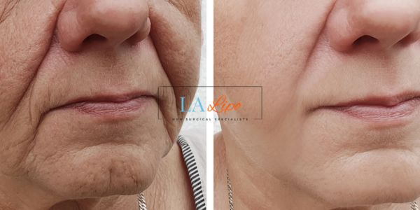 Older lady deeper wrinkle reduction - LA LIPO Morpheus 8 Results Luton