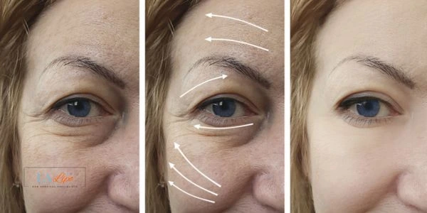 Amazing eye lift Morpheus 8 results Luton
