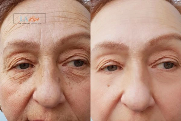 The powerful benefits of Morpheus8 Treatment Luton - Call Our team today!