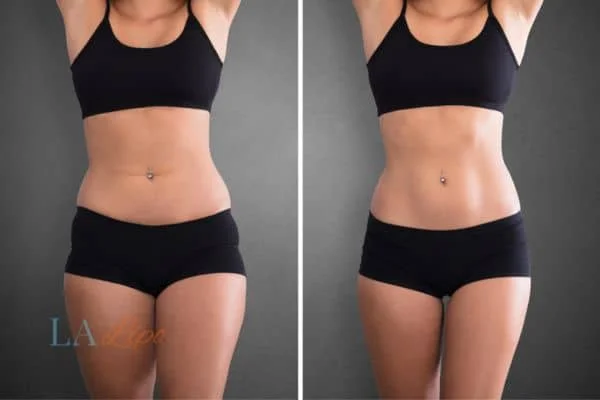 before and after results of non-surgical treatment to help a woman's body image and mental health Luton