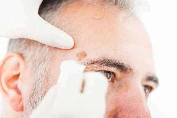 Age spots and elderly people Luton what is the link?