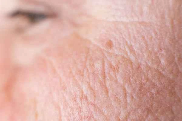 close up picture of a woman's face showing an age spot Luton