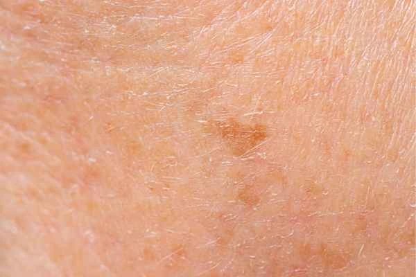 close up picture of age spots Luton