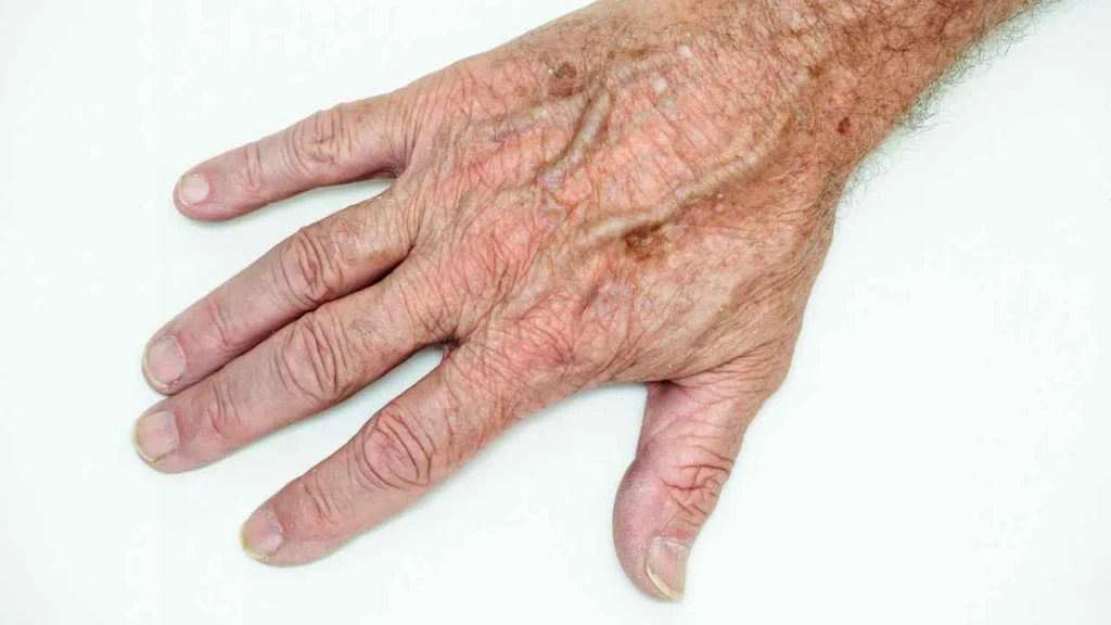 Male hand showing age spot Luton
