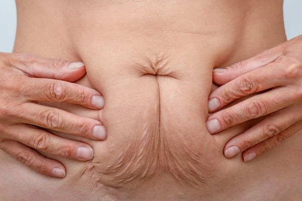 Image of a woman's stomach with loose skin - example of skin tightening Luton options