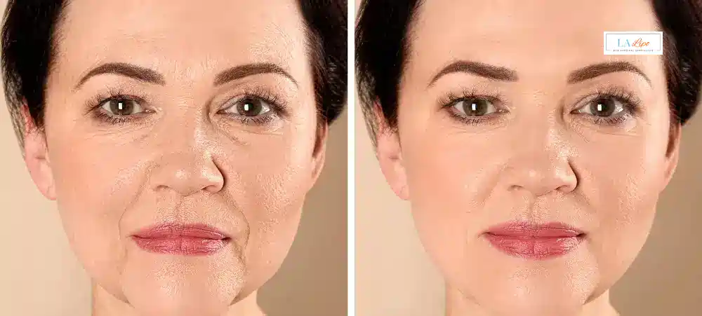 How Long Does It Take to See Results and How Long Do They Last Luton?