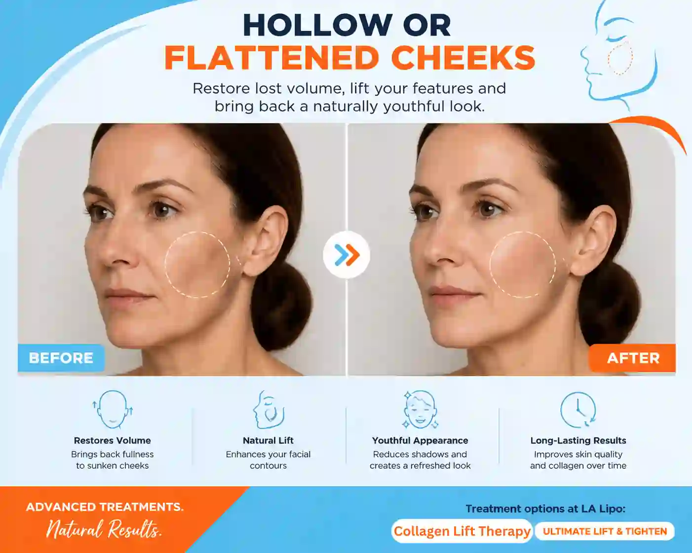 Sign #4: Hollow or Flattened Cheeks Luton