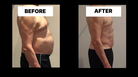 What Symptoms Can Diastasis Recti Cause in Men? Weak Core, Back Pain and Poor Posture Luton